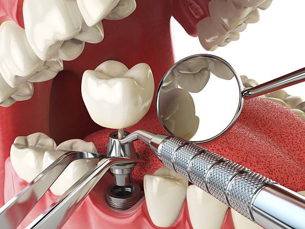 Best Emergency Dental Care for Broken or Chipped Teeth in Midway, KY